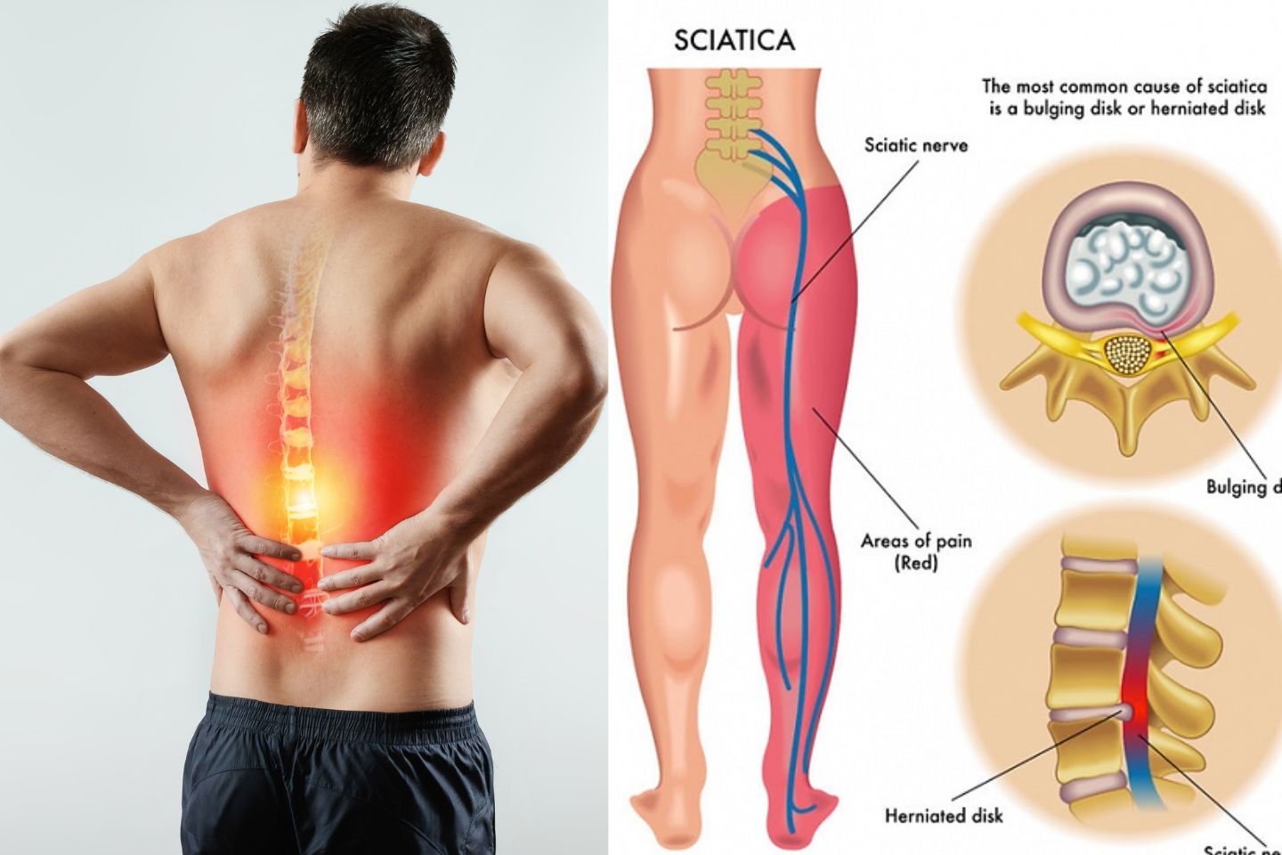 Sciatica wedge outlet