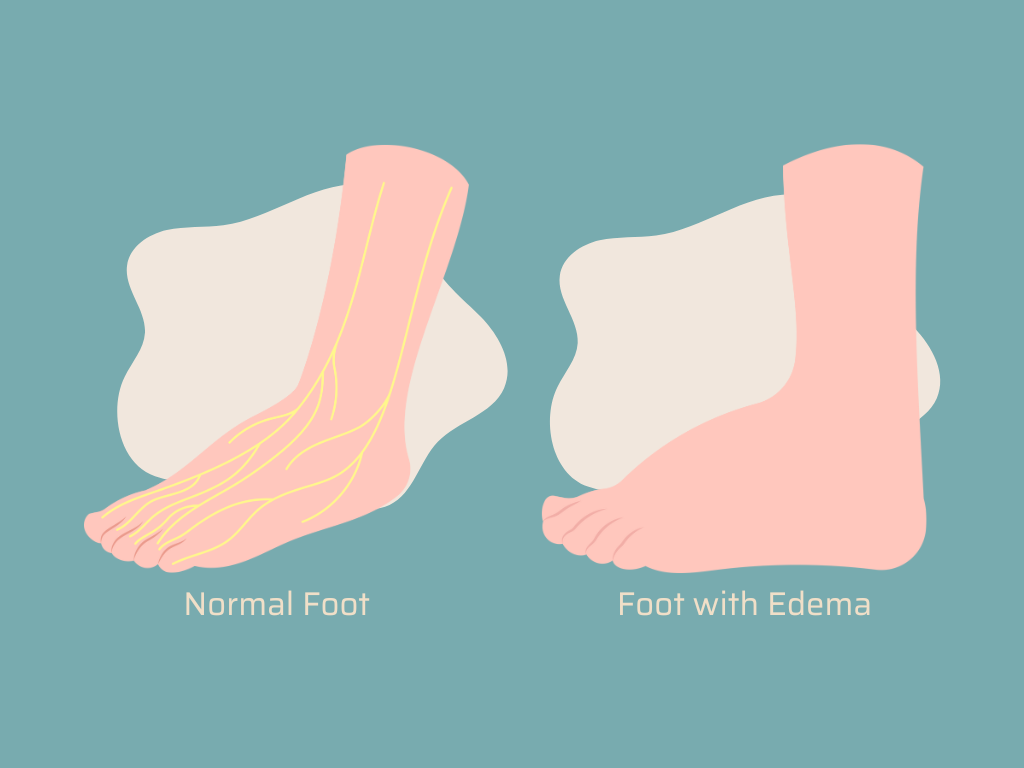 Normal foot and foot with Edema
